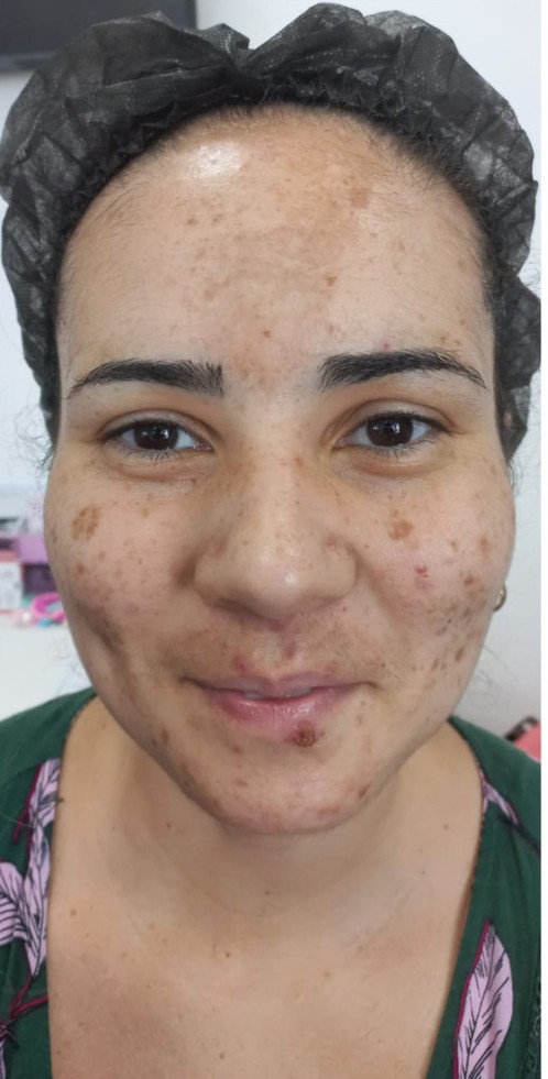 Antes do Peeling Químico