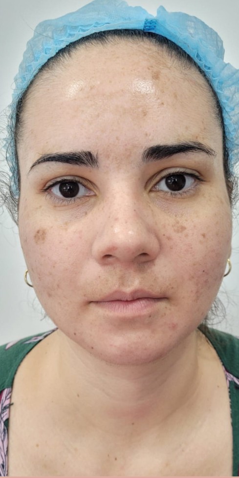 Depois do Peeling Químico